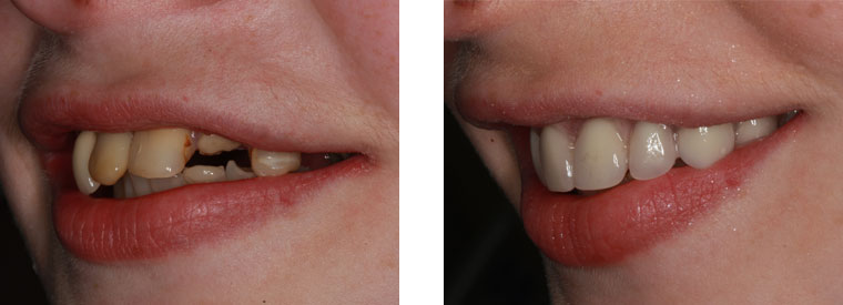 Dental implants before & after