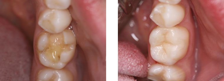 Dental Inlays before & after