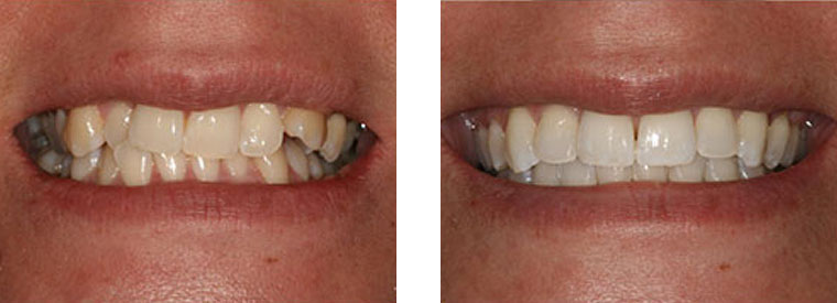 Six Month Smiles before & after