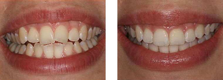 Six Month Smiles before & after