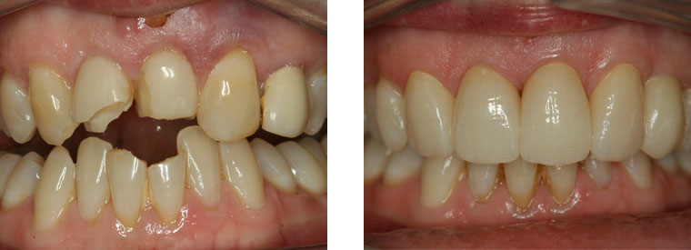 Trauma, dental crown and dental implant case before & after