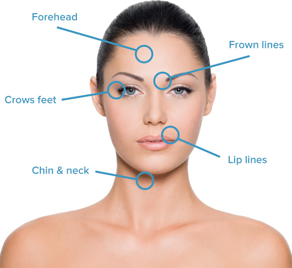 BOTOX in Fulham & Hammersmith