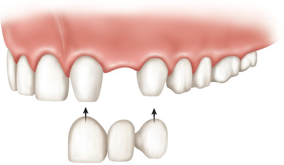 Dental bridges in Fulham & Hammersmith