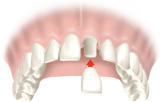 Dental crowns in Fulham & Hammersmith