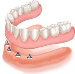 Dentures in Fulham & Hammersmith