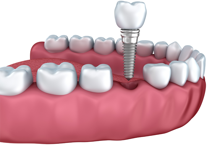 Dental implants in Fulham & Hammersmith