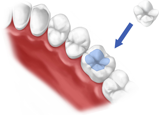 Dental inlays & inlays in Fulham & Hammersmith