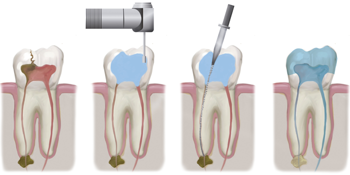 Root canal treatments in Fulham & Hammersmith