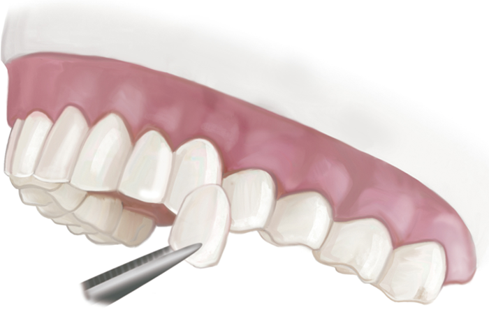 Dental veneers in Fulham & Hammersmith