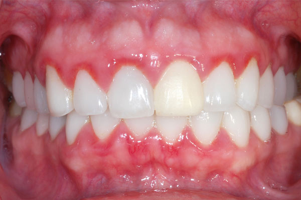 Gingivitis