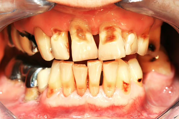 Periodontitis